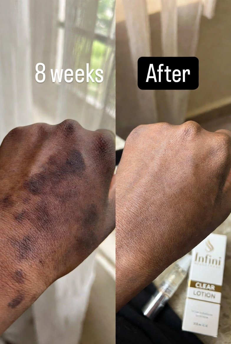 Infini Clear Lotion Before - Day 1 dark knuckles and elbows